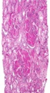 The Association Between Erythrocyte Sedimentation Rate, C3, C4, Anti-dsDNA Levels, and Renal Disease Activity, Based on BILAG Index in Females With Lupus Nephritis